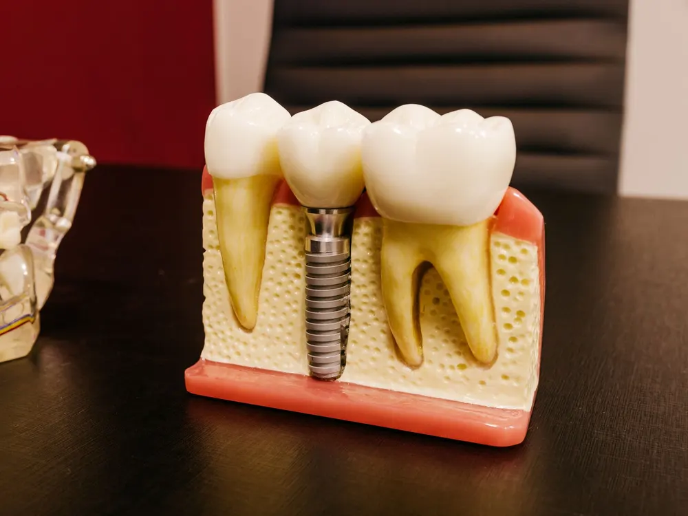 Modelo de implante dentário